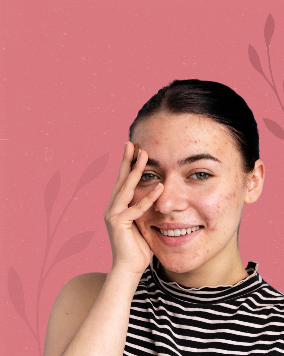 Acne Care